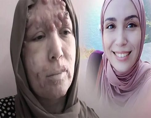 مرض نادر أوجع قدها وأحزن قلبها فأدمت قصتها قلوب رواد التواصل مرض نادر أوجع قدها وأحزن قلبها فأدمت قصتها قلوب رواد التواصل