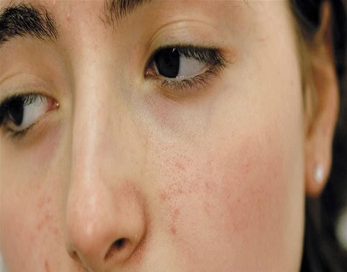 علاجات طبيعية لمشكلة حفر الوجه .. جربيها علاجات طبيعية لمشكلة حفر الوجه .. جربيها