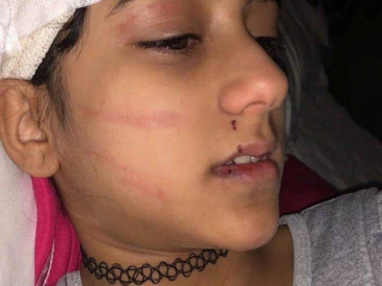 طفلة تنجو بأعجوبة من مخالب نمر اعتدى عليها وأصابها بوجهها طفلة تنجو بأعجوبة من مخالب نمر اعتدى عليها وأصابها بوجهها