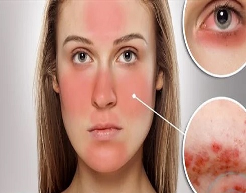 طريقة علاج الحروق في المنزل