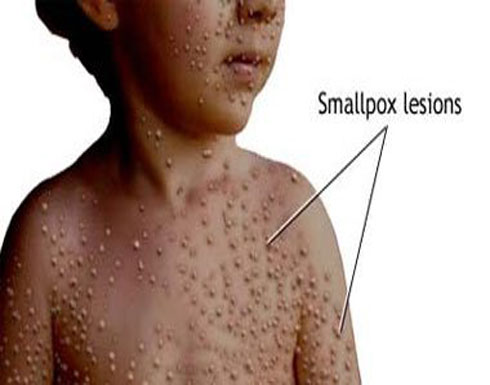 حقائق يجب معرفتها عن مرض الجديرى المائى