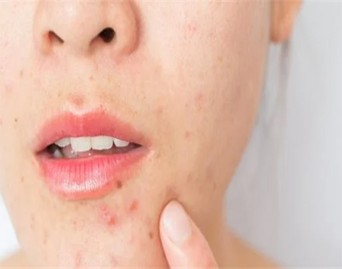دون كيماويات.. مكونات منزلية تعالج حب الشباب خلال ساعات دون كيماويات.. مكونات منزلية تعالج حب الشباب خلال ساعات