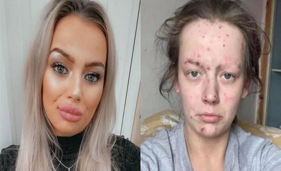بالصور..مدمنة مخدرات قبل وبعد التعافي بالصور..مدمنة مخدرات قبل وبعد التعافي
