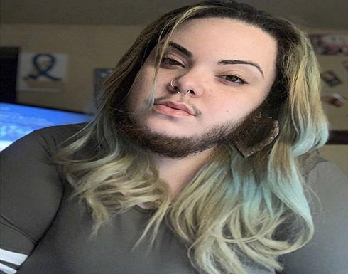 فتاة تطلق لحيتها بسبب مرض هرموني .. صورة فتاة تطلق لحيتها بسبب مرض هرموني .. صورة