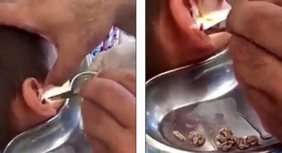 بالفيديو: شعرَ بألم في أذنه.. ولن تصدّقوا ماذا اكتشف الطبيب! بالفيديو: شعرَ بألم في أذنه.. ولن تصدّقوا ماذا اكتشف الطبيب!