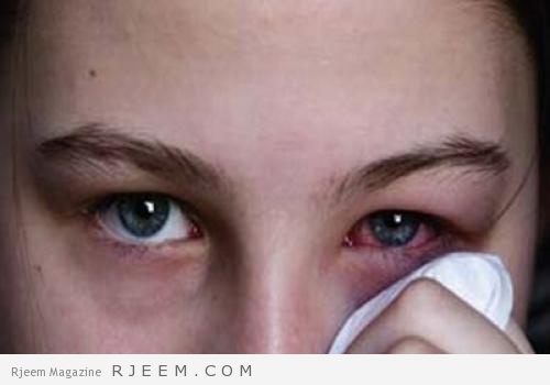 مرض رمد العين