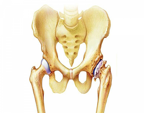 النتوءات العظمية.. تتشكل بسبب التآكل المصاحب لالتهاب المفاصل
