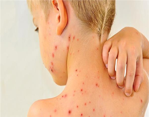 مرض الحصبة يدمر الجهاز المناعى ويسبب محو ذاكرة المناعة لدى الأطفال مرض الحصبة يدمر الجهاز المناعى ويسبب محو ذاكرة المناعة لدى الأطفال