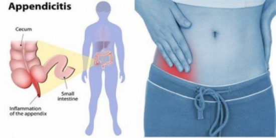 إلتهاب الزّائدة الدوديّة appendicitis : الأعراض والعلامات وأهمّيّة التدخّل المبكّر إلتهاب الزّائدة الدوديّة appendicitis : الأعراض والعلامات وأهمّيّة التدخّل المبكّر