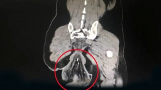 أمر خطير حصل أصابه بسبب الاستخدام المطوّل للهاتف أثناء الجلوس على كرسي الحمام! أمر خطير حصل أصابه بسبب الاستخدام المطوّل للهاتف أثناء الجلوس على كرسي الحمام!