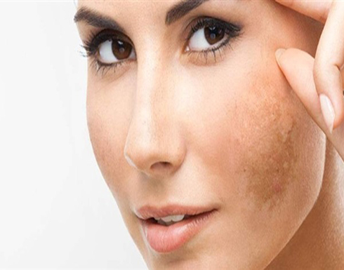 علاج كلف الحمل بعد الولادة.. التوقف فورا عن تناول حبوب منع الحمل علاج كلف الحمل بعد الولادة.. التوقف فورا عن تناول حبوب منع الحمل