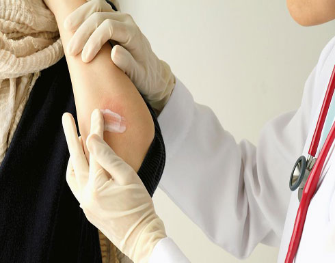 لتخفيف أعراض الصدفية.. إليك بالطب البديل لتخفيف أعراض الصدفية.. إليك بالطب البديل